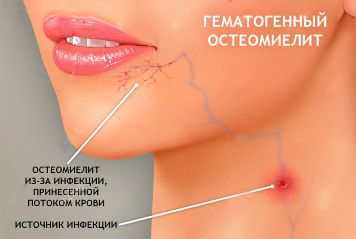 Хематогенен остеомиелит