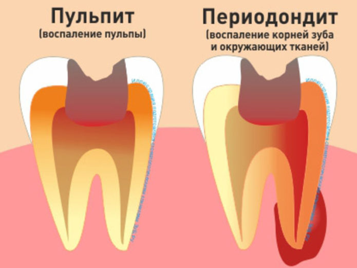 Заболявания на зъбите