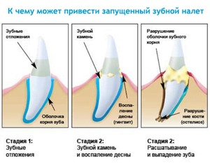 Етапи на плака - визуална схема