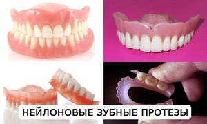 Подвижни найлонови зъби - опция за протезиране