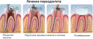 Процедура за лечение на периодонтит Как за лечение на периодонтит