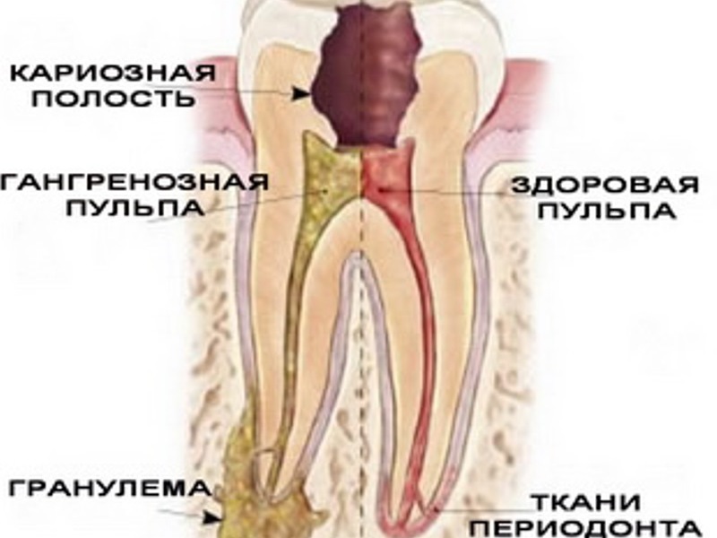 Схема на периодонтит Как изглежда зъбът на периодонтит?