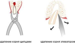 Инструменти за отстраняване на зъбни корени