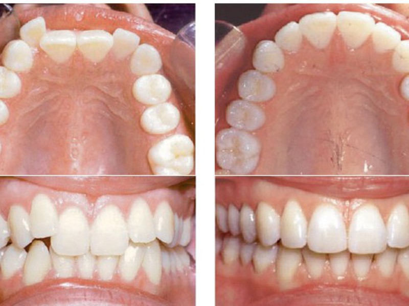 Ivisalign скоби преди и след Резултат от Ivisalign скоби