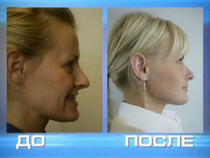 Методи за корекция на захапката